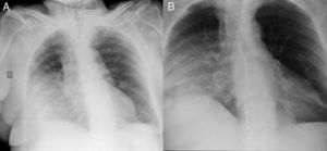 A) Radiografía de tórax donde se visualiza consolidación parenquimatosa en campo medio y base pulmonar derecha. B) Radiografía de tórax con mejoría de la consolidación y pérdida de volumen de dicho hemitórax y/o elevación hemidiafragmática.