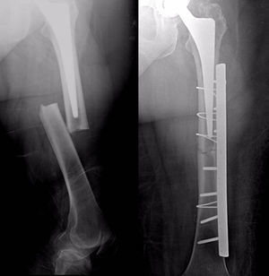 Radiografía AP de pelvis donde se aprecian las 2 prótesis totales de cadera, sin evidentes signos de movilización, si bien la derecha, cementada, pudiera estar hundida.