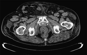 Imagen TAC abdominopélvica en la que se aprecia en la porción más distal del recto, en la cara posterolateral derecha, un área con pequeñas burbujas aéreas excéntricas que sugieren microperforación.