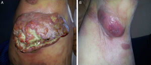 A) Masa axilar derecha gigante con datos de necrosis y sobreinfección. B) Lesión tumoral incipiente axilar izquierda.