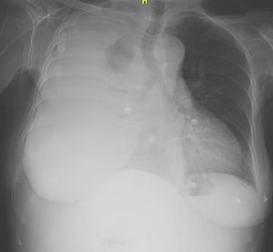 Radiografía de tórax posteroanterior que muestra derrame pleural masivo derecho.