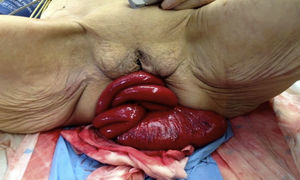 Evisceración de intestino delgado por perineo posterior.