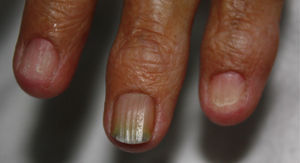 Lecho ungueal con ausencia de lámina (onicomadesis) del 2.° y 4.° dedo.