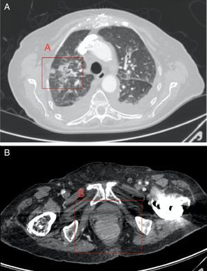 A) Metástasis pulmonares, en lóbulo superior derecho. B) Lesión de partes blandas en tercio inferior de recto y canal anal.