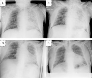 Imágenes de radiografías de tórax en nuestro paciente, secuencia temporal: A y B) Tomadas en el momento de la presentación del cuadro clínico. Evidencia infiltrados pulmonares alveolares bilaterales, más llamativos en pulmón izquierdo. C) Dos semanas después de suspender la daptomicina. D) Dos meses después de retirar la daptomicina.