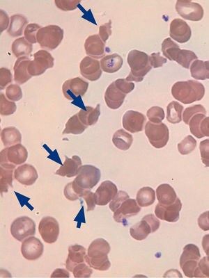 Frotis de sangre periférica con esquistocitos (flechas).