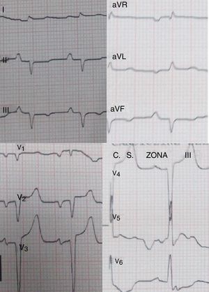 ECG del caso 2 que muestra ritmo sinusal, patrón de seudoinfarto (ondas Qs patológicas en cara inferior y en precordiales hasta V4).