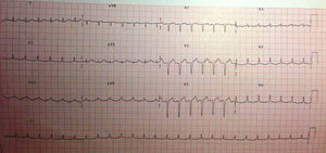 ECG al ingreso: taquicardia regular con QRS estrecho, QS de V1-V3 y T aplanada en cara lateral.