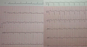 ECG durante el dolor torácico: taquicardia sinusal con QRS estrecho, QS en V1-V2 junto con ST convexo, y T negativa de V2 a V6 y también en II-III y aVF.