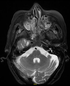 Resonancia magnética, T2 hipointenso sugerente de masa tumoral en la región posterior de ambas fosas nasales, clivus y senos cavernosos.