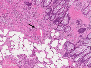Hendidura en forma de aguja «cristal de colesterol» en el interior de una arteriola. Detalle HE, 20×.