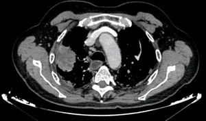Masa pulmonar con contacto pleural en el lóbulo superior derecho.