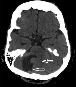 Neuroimagen de TC cerebral de la paciente que muestra la falta de fusión de hemisferios cerebelosos. Megacisterna magna comunicada con el cuarto ventrículo.