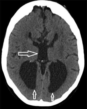 Neuroimagen de TC cerebral de la paciente compatible con diagnóstico de síndrome de Dandy-Walker, con la representativa dilatación de astas posteriores y tercer ventrículo.