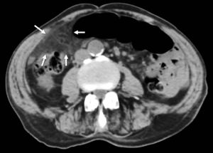 Imagen de la TC abdominal mostrando un aumento de densidad con trabeculación de la grasa epiploica en fosa ilíaca derecha, adyacente al colon, con efecto masa.
