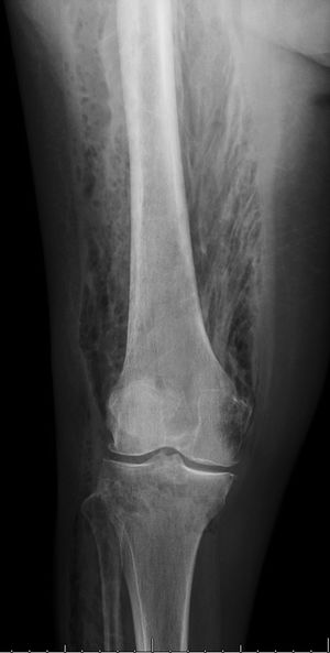 Radiografía simple, proyección antero-posterior. Detalle de miembro inferior derecho, en el que se aprecian colecciones de gas en la musculatura de muslo y pierna sugerentes de fascitis necrosante.