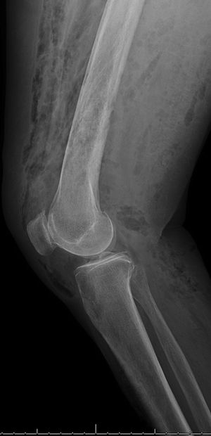 Radiografía simple, proyección lateral. Detalle de miembro inferior derecho, en el que se aprecian colecciones de gas en la musculatura de muslo y pierna sugerentes de fascitis necrosante.
