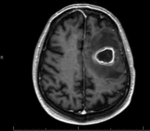 Resonancia magnética, corte transversal. Hallazgos compatibles con absceso cerebral frontal izquierdo con una extensa zona de cerebritis circundante.