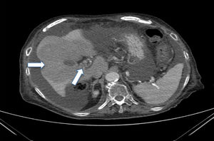 Imagen de trombosis de la vena mesentérica superior y de la porta con cavernomatosis. Área isquémica extensa hepática y presencia de abundante líquido libre intraperitoneal.
