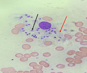 Biopsia de médula ósea. Tinción hematoxilina-eosina. Visión de microscopia óptica. Se observa voluminoso histiocito (flecha roja) cargado con abundantes parásitos intracelulares compatibles con amastigotes de Leishmania (flecha negra).