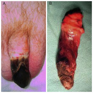 A) Necrosis de pene. B) Vista macroscópica de pieza de penectomía total.