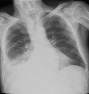 Radiografía de tórax AP: neumonía derecha con derrame pleural ipsilateral.