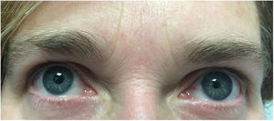 Anisocoria con presencia de midriasis en pupila derecha.