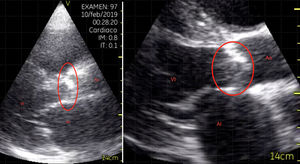 Plano paraesternal eje largo: estenosis aórtica. AI: aurícula izquierda; Ao: aorta; VI: ventrículo izquierdo.