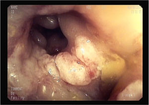 Imagen de colonoscopia. Equimosis, edema y ulceraciones extensas localizadas en el borde antimesentérico.