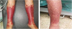 Extremidades inferiores con lesiones purpúricas previamente al tratamiento corticoideo (A) y tras el tratamiento (B).