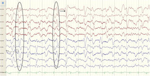EEG con ondas trifásicas (círculo) con intervalo de aparición corto (flecha), característico de encefalopatía tóxico-metabólica.