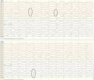 EEG con anomalías focales asíncronas (círculo) en ambos lóbulos temporales (arriba lóbulo temporal izquierdo, abajo lóbulo temporal derecho).