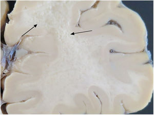 Anatomía patológica, macroscópico: focos de desmielinización de sustancia blanca subcortical con aspecto cribiforme.