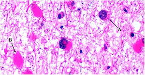 Anatomía patológica, microscópico: A) oligodendrocitos con núcleos hipercromáticos, lobulados y con inclusiones virales intranucleares, y B) astrocitos de gran tamaño.