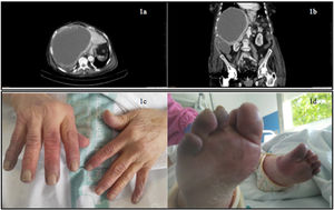 Cistoadenocarcinoma hepático y síndrome paraneoplásico vascular acral: a y b) Imagen de tomografía computarizada dónde se observa una masa de 20cm compatible con cistoadenocarcinoma hepático; c y d) Acrocianosis distal asimétrica en manos y pies.