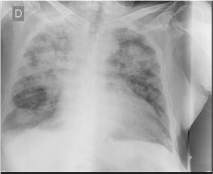 Neumonía bilateral por Covid-19.