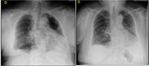 Cambio radiológico en paciente tratada con ozono rectal (cinco sesiones de tratamiento), según escala de Taylor. Radiografía de tórax, 2 de mayo 2020: calcificación de prótesis mamarias. Disminución de volumen del pulmón izquierdo. Importante condensación parenquimatosa en el LII. Infiltrados intersticiales alveolares parcheados afectando al resto de ambos pulmones, quedando una pequeña zona respetada, probablemente hiperinsuflado en el vértice izquierdo. Engrosamiento pleural bilateral. Escasos cambios con respecto a la radiografía previa realizada el día 19 de abril. Sugerente de neumonitis por COVID-19. Grado 5. Radiografía, 6 de mayo 2020: neumonía bilateral. Marcada mejoría con respecto a controles previos. Pulmón derecho: Se mantiene un infiltrado alveolar e intersticial en pulmón derecho, especialmente en lóbulo inferior con engrosamiento pleural adyacente. Pulmón izquierdo ha mejorado considerablemente el infiltrado alveolar del lóbulo inferior, la pérdida de volumen y el componente de engrosamiento pleural. Persiste la afectación intersticial, fibrosis y engrosamiento pleural. Grado 3 moderado.
