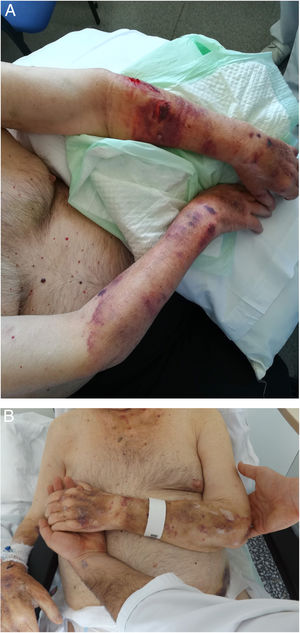 Clinical image at presentation (A) and after 2 weeks of treatment (B).