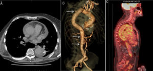 Hematoma intramural aórtico en paciente con aortitis. Imágenes de TC y PET/TC. A) Corte axial de la aorta torácica descendente, obtenido tardíamente tras la administración de contraste. Se observa imagen en semiluna hiperdensa en la pared posterior de la aorta (flecha), característica del hematoma intramural. Derrame pleural izquierdo adyacente. B) Reconstrucción 3D de la aorta tras la administración de contraste en la que destacan pequeños acúmulos de contraste —acúmulos hemáticos intramurales— también característicos del hematoma intramural (flechas). A diferencia de las úlceras, estas tienen cuello ancho y suelen verse en aortas con ateromatosis difusa calcificada. C) PET/TC. Marcado engrosamiento mural circunferencial de la aorta en toda su extensión, intensamente hipermetabólico y difuso, con intensa captación del trazador en la aorta en toda su extensión. También se detectaba hipermetabolismo perivascular a nivel de las arterias carótidas, subclavias, tronco braquiocefálico derecho, arterias ilíacas internas, externas y femorales.
