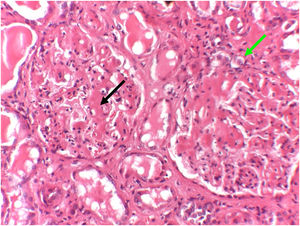Tinción hematoxilina-eosina. Microscopía óptica (x20). Se observan dos glomérulos renales con extenso material amiloidótico depositado. La flecha negra señala el extenso infiltrado amiloidótico distribuido a lo largo del mesangio glomerular. La flecha verde señala el depósito de amiloide alrededor de los capilares glomerulares.