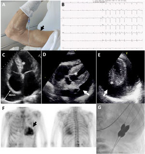 A (flecha)Signo de Popeye: rotura atraumática del tendón del bíceps. B)Electrocardiograma de 12derivaciones: fibrilación auricular con bajos voltajes en derivaciones bipolares y patrón de pseudoinfarto en precordiales. C)Ecocardiograma transtorácico (ETT) plano apical 4cámaras que muestra hipertrofia ventricular izquierda (HVI) severa (asterisco), dilatación biauricular severa y derrame pericárdico (DP) retroauricular derecho (38mm). D)ETT plano subcostal: HVI (asterisco) y DP asimétrico (flecha). E)ETT plano paraesternal eje corto a nivel apical: HVI (asterisco) y DP (flecha). F)Gammagrafía miocárdica con pirofosfatos con captación miocárdica intensa (flecha). G)Inflado simultáneo de balones de valvuloplastia durante la pericardiotomía percutánea con balón.
