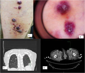 A) Pápulas y nódulos violáceos en miembros inferiores. B) Dermoscopia (Dermlite DL10). Patrón en arco iris. C) Opacidad pulmonar central y periférica con condensación de 33 mm con signo de halo invertido D) Adenopatías inguinales múltiples.