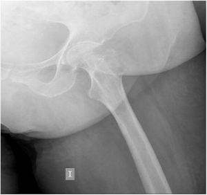 Radiografía de cadera izquierda. Se objetiva imagen lítica a nivel del trocánter mayor. Fuente: colección propia.