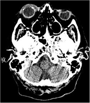 Celulitis postseptal y endoftalmitis de ojo derecho.