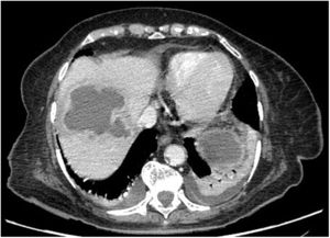 Abscesos hepáticos y esplénicos.