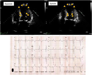 In the echocardiogram, triangles show apical akinesia a ballooning and stars show hypercontractility in bases. The EKG shows a sinus rhythm with complete AV block and a ventricular pacemaker stimulation that causes a broad QRS and leftward QRS axis, with a concordant repolarization image in D-I.