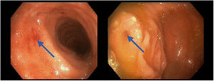 Colonoscopia. Imágenes tomadas de la ampolla rectal. Las flechas azules muestran la afectación parcheada de la mucosa rectal compatible con colitis con grado severo de inflamación asociado.