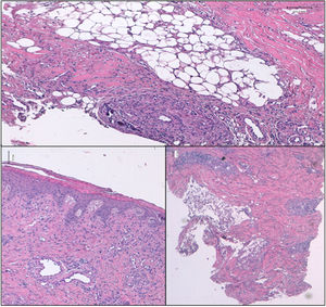 Histopatología de lesión cutánea del muslo derecho: engrosamiento de los vasos capilares con calcificación parcial de la túnica media, extensa fibrosis del panículo adiposo y necrosis grasa. Epidermis con datos de paraqueratosis. Datos compatibles (no concluyentes) de calcifilaxia no urémica. Las tinciones son todas hematoxilina eosina (H-E) y los aumentos son 4X y 20X.