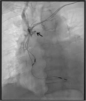 Radioscopia del intervencionismo de colocación catéter venoso central, con ausencia de flujo de hacia vena cava superior (flecha).