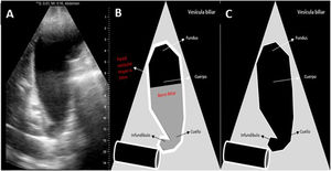 A). Corte longitudinal de la vesícula biliar donde se observa diagnóstico ecográfico de colecistitis aguda y barro biliar. B) Representación esquemática de la vesícula biliar con diagnóstico ecográfico de colecistitis aguda. C) Representación esquemática de la vesícula biliar normal.